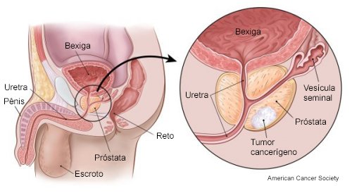 dúvidas sobre o câncer de próstata