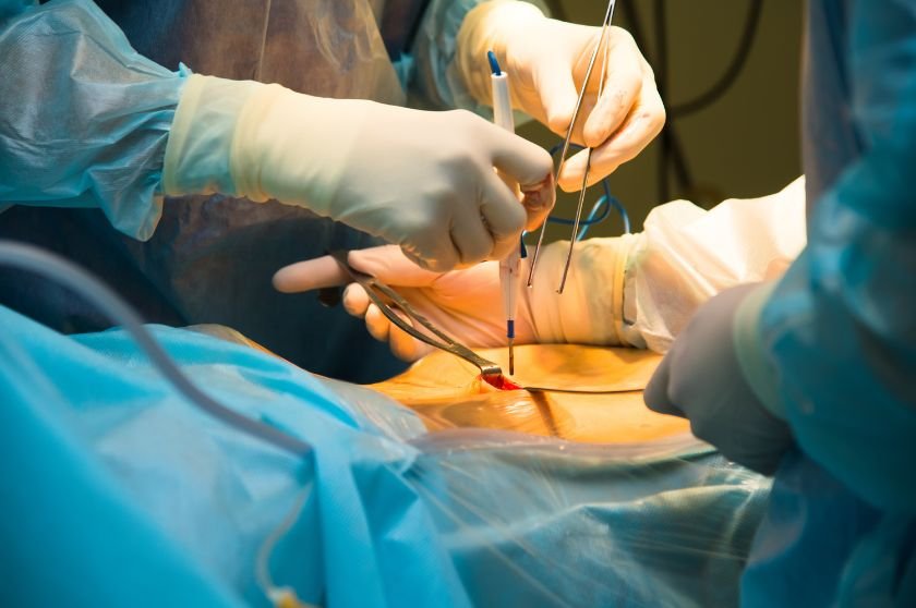 Cirurgiões realizando procedimento laparoscópico com pequenas incisões no abdômen.