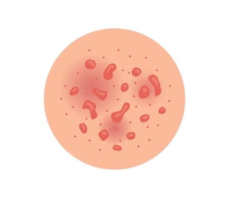 Ilustração de células inflamadas vistas em detalhe.